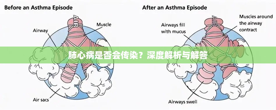 肺心病是否會傳染？深度解析與解答